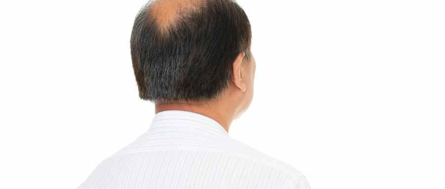 精神压力引起的脱发可以治疗吗
